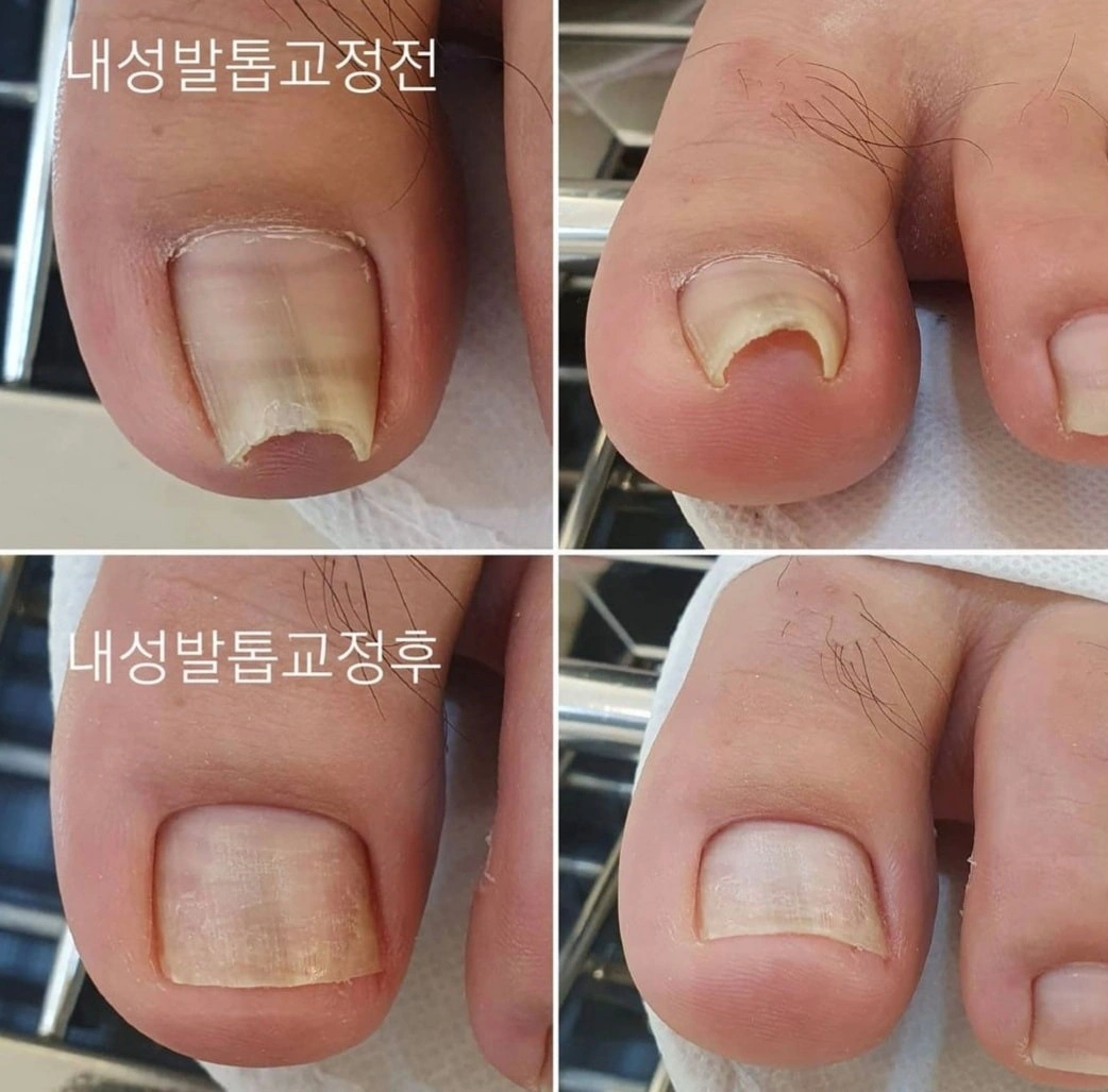 발톱을 둥글게 깎는 습관이 만드는 조갑감입증