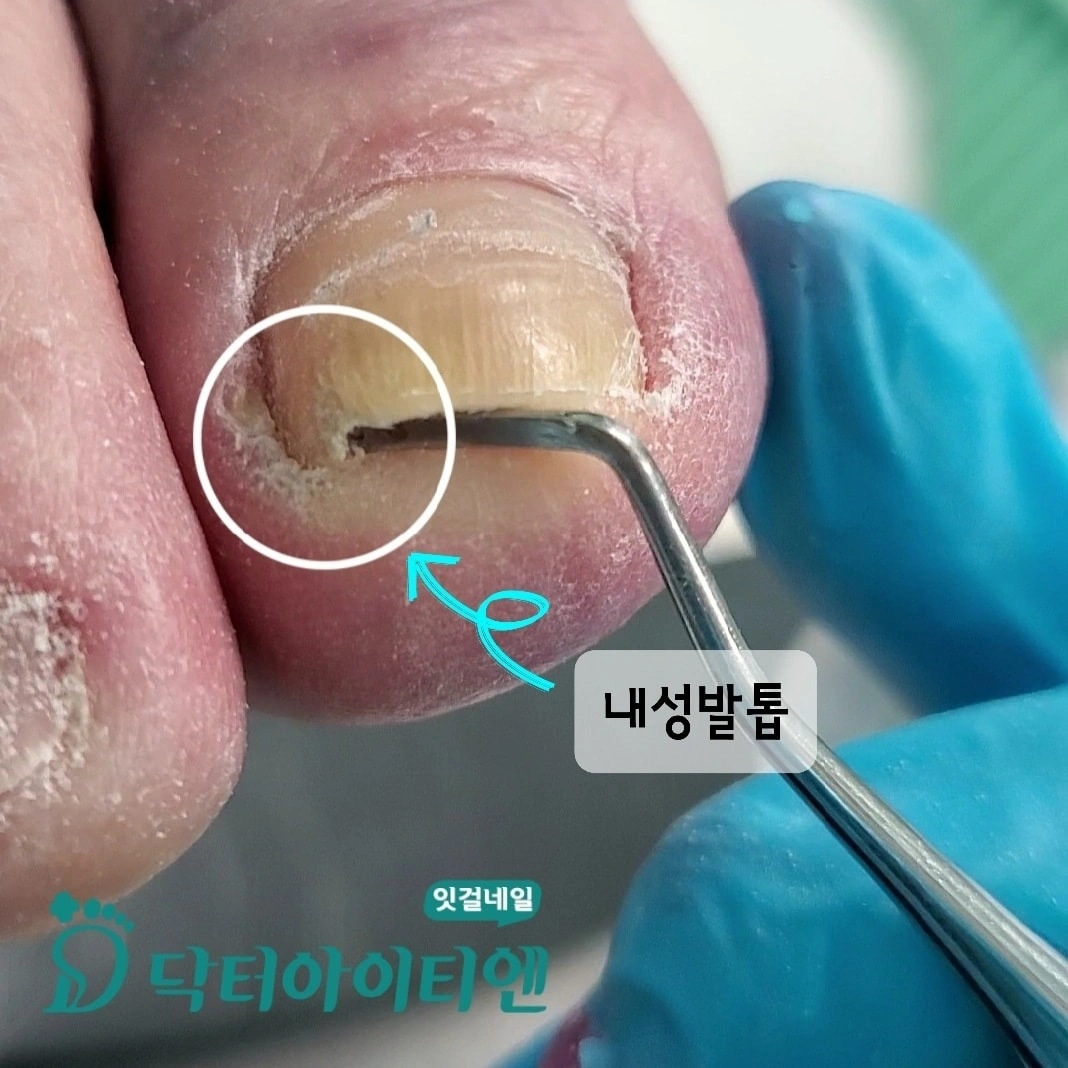 꽉 끼는 신발과 외상이 유발하는 지속적 압박
