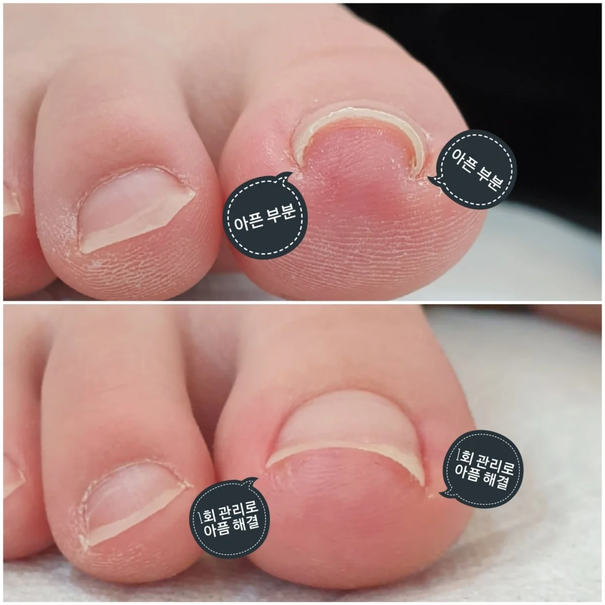붉어짐과 압통으로 시작하는 초기 증상